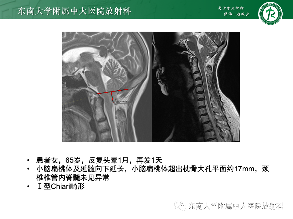 影像PPT - 【PPT】小脑扁桃体下疝畸形-11 影像PPT - 【PPT】小脑扁桃体下疝畸形-11