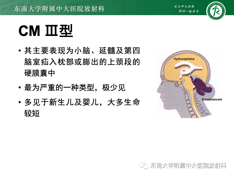影像PPT - 【PPT】小脑扁桃体下疝畸形-16 影像PPT - 【PPT】小脑扁桃体下疝畸形-16