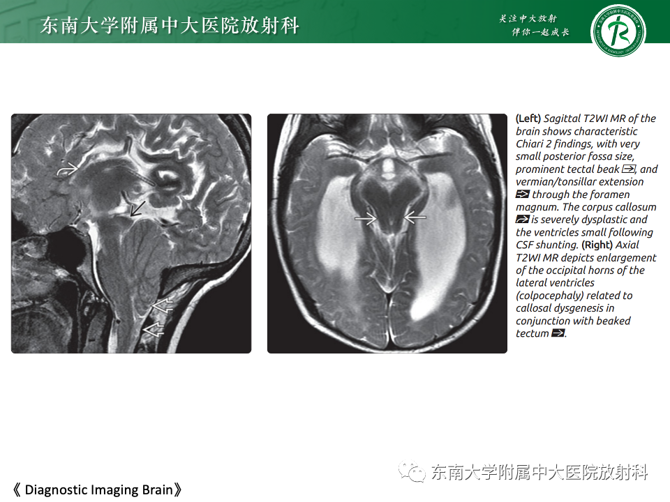 影像PPT - 【PPT】小脑扁桃体下疝畸形-14 影像PPT - 【PPT】小脑扁桃体下疝畸形-14