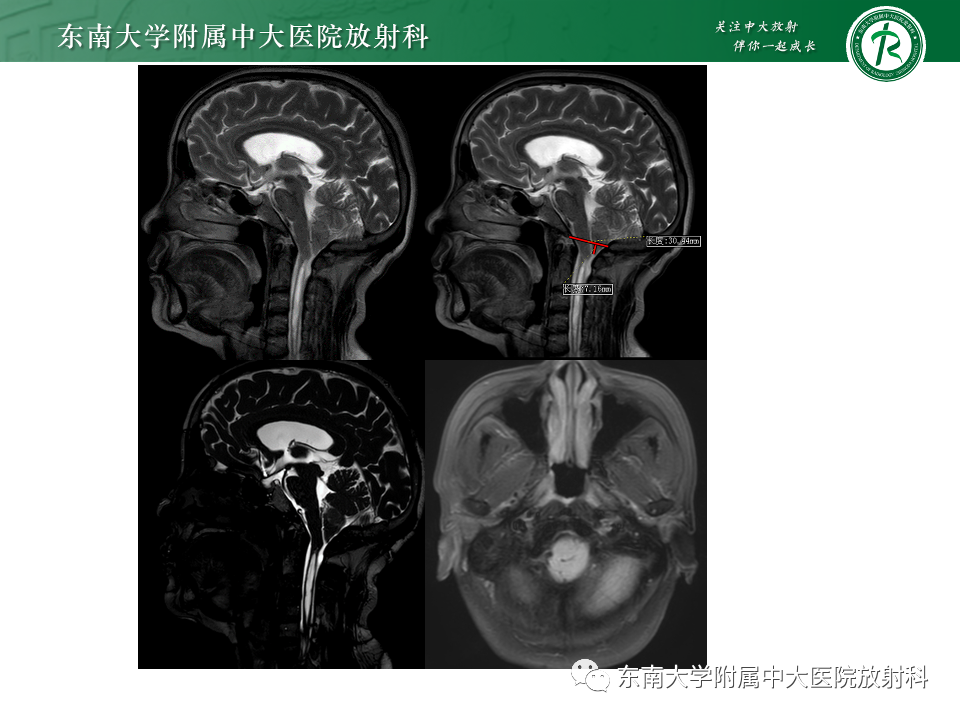 影像PPT - 【PPT】小脑扁桃体下疝畸形-3 影像PPT - 【PPT】小脑扁桃体下疝畸形-3
