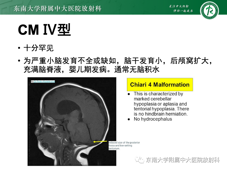 影像PPT - 【PPT】小脑扁桃体下疝畸形-18 影像PPT - 【PPT】小脑扁桃体下疝畸形-18