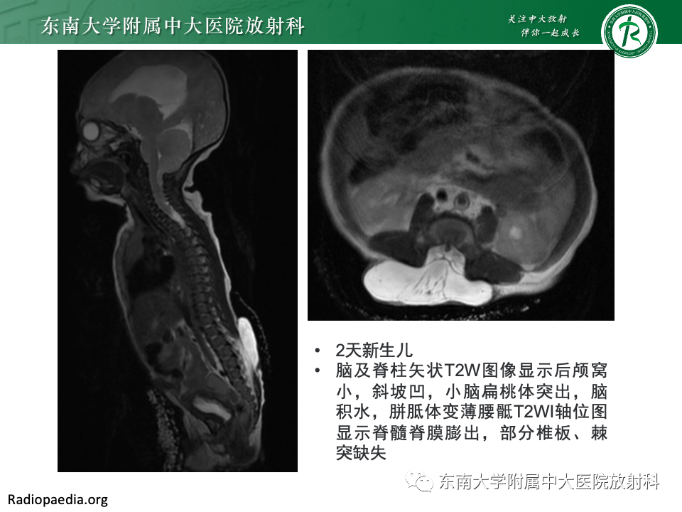 影像PPT - 【PPT】小脑扁桃体下疝畸形-15 影像PPT - 【PPT】小脑扁桃体下疝畸形-15