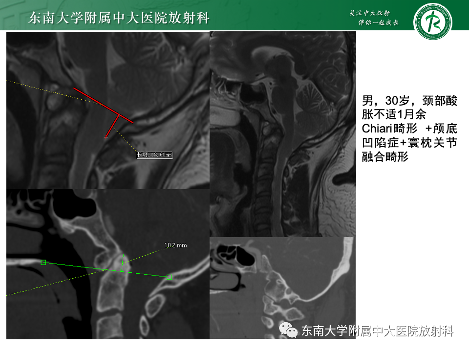 影像PPT - 【PPT】小脑扁桃体下疝畸形-23 影像PPT - 【PPT】小脑扁桃体下疝畸形-23