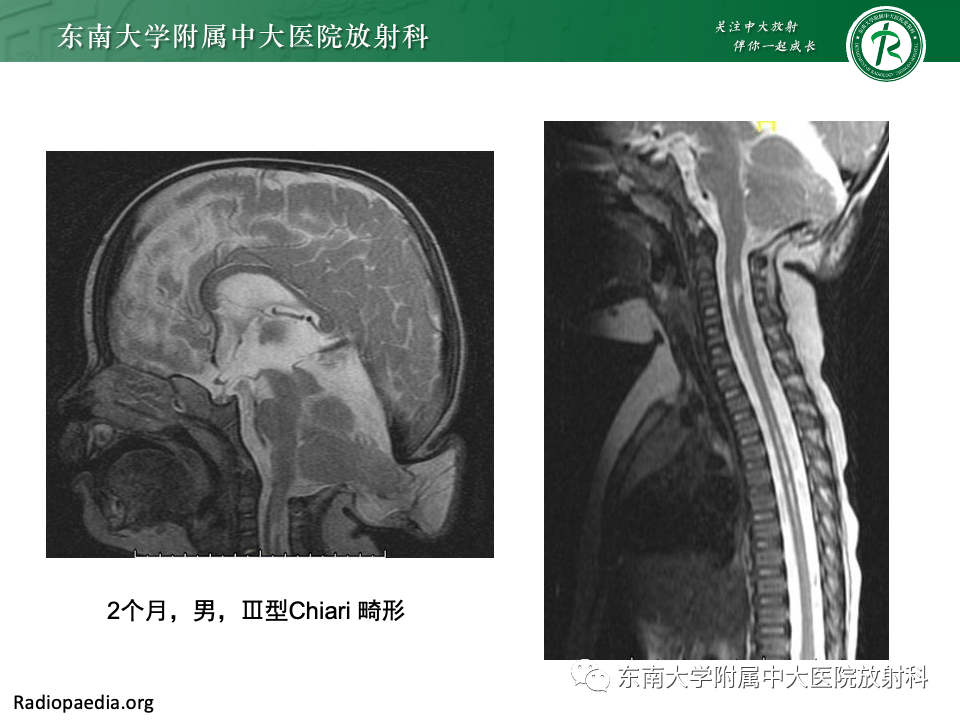 影像PPT - 【PPT】小脑扁桃体下疝畸形-17 影像PPT - 【PPT】小脑扁桃体下疝畸形-17