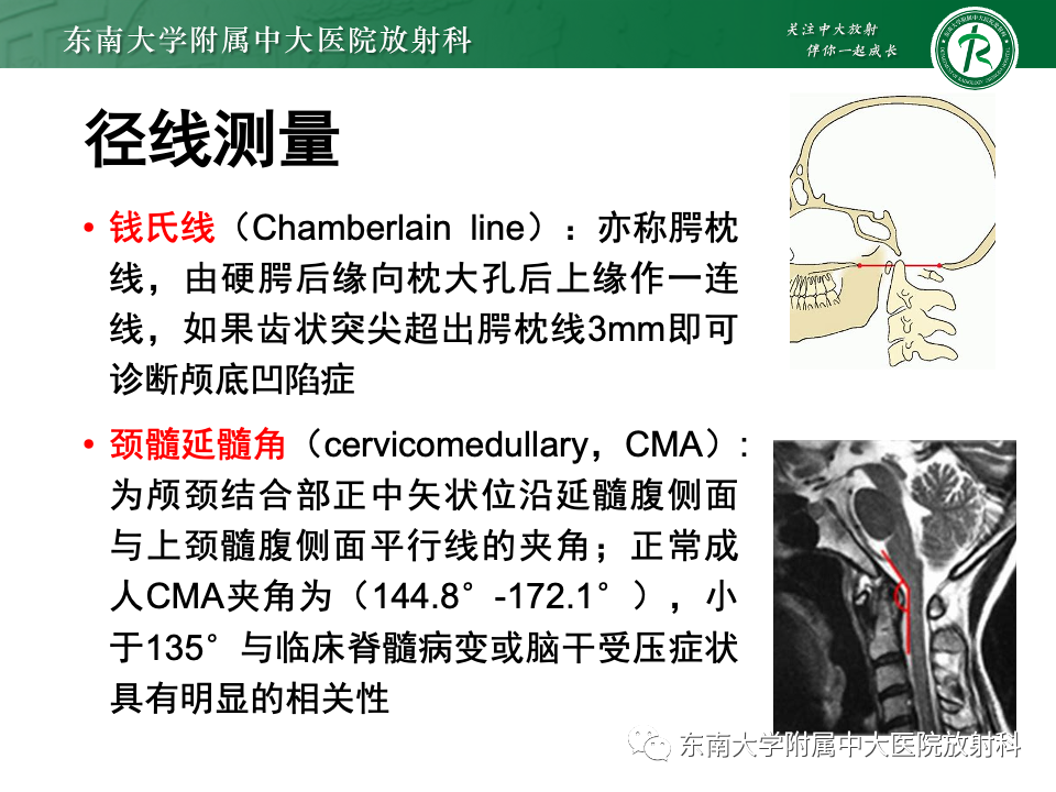 影像PPT - 【PPT】小脑扁桃体下疝畸形-21 影像PPT - 【PPT】小脑扁桃体下疝畸形-21