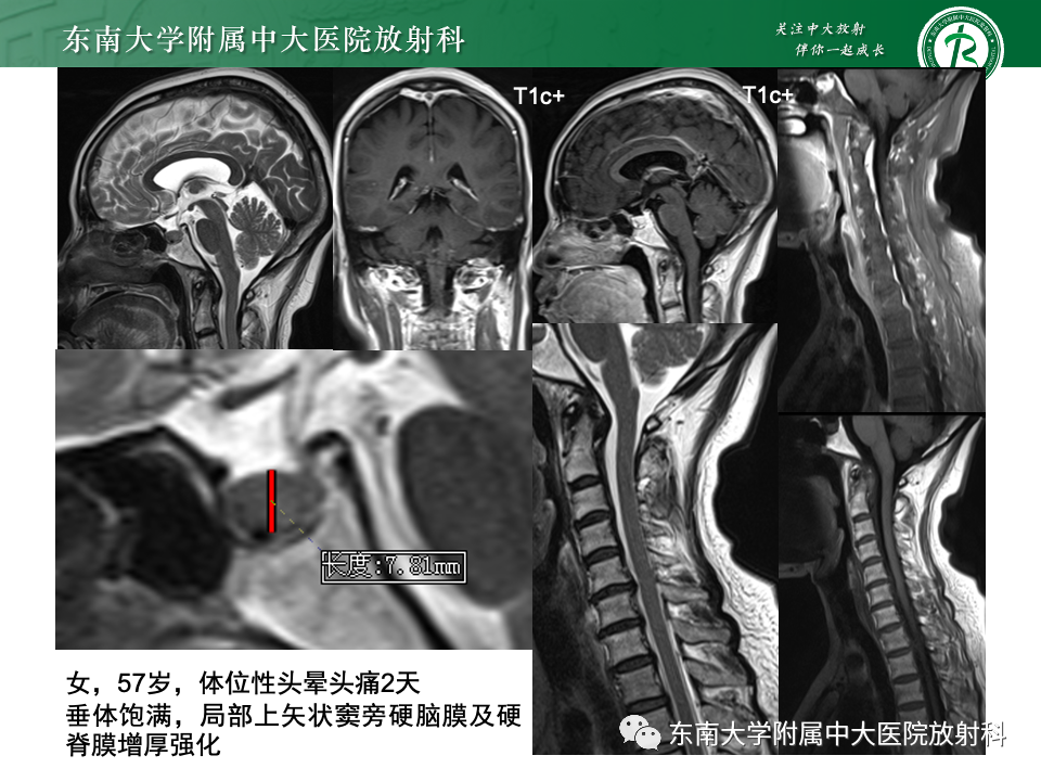 影像PPT - 【PPT】小脑扁桃体下疝畸形-27 影像PPT - 【PPT】小脑扁桃体下疝畸形-27