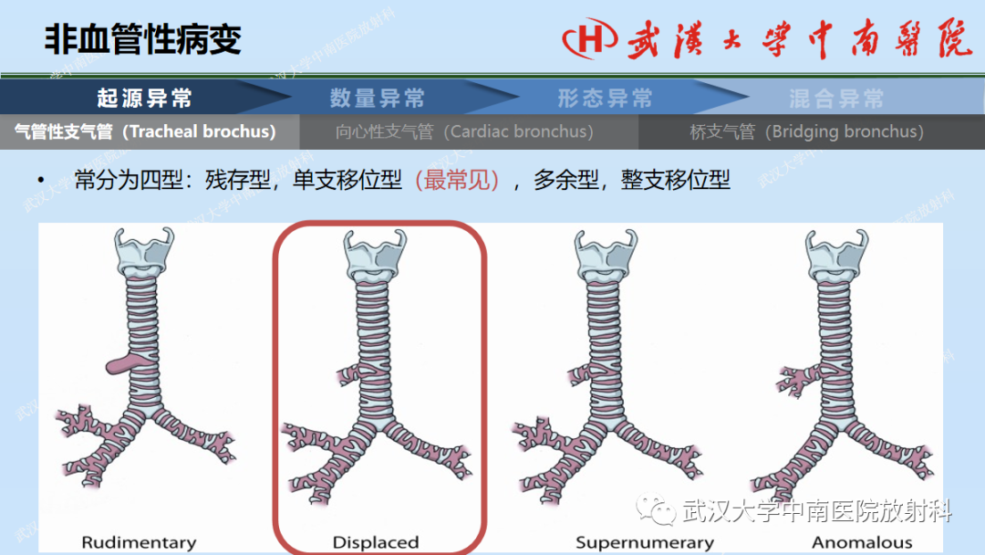 影像PPT - 【PPT】先天性气道异常-7