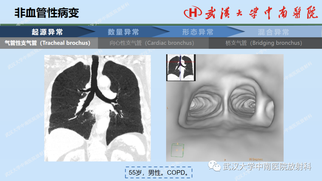 影像PPT - 【PPT】先天性气道异常-9