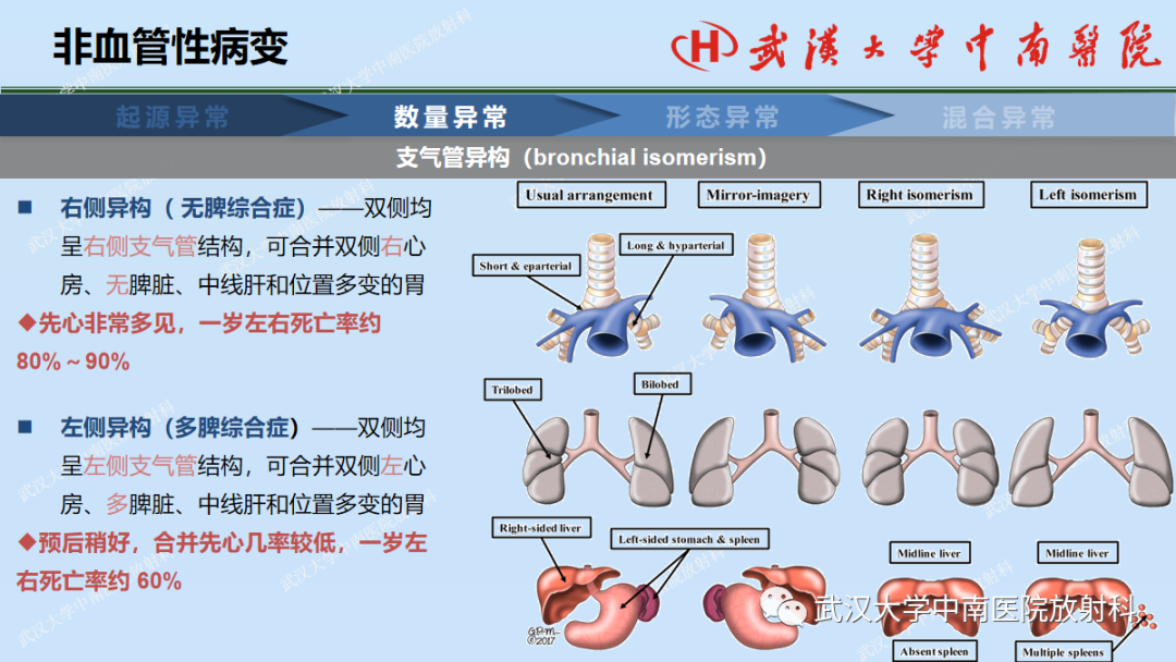 影像PPT - 【PPT】先天性气道异常-19