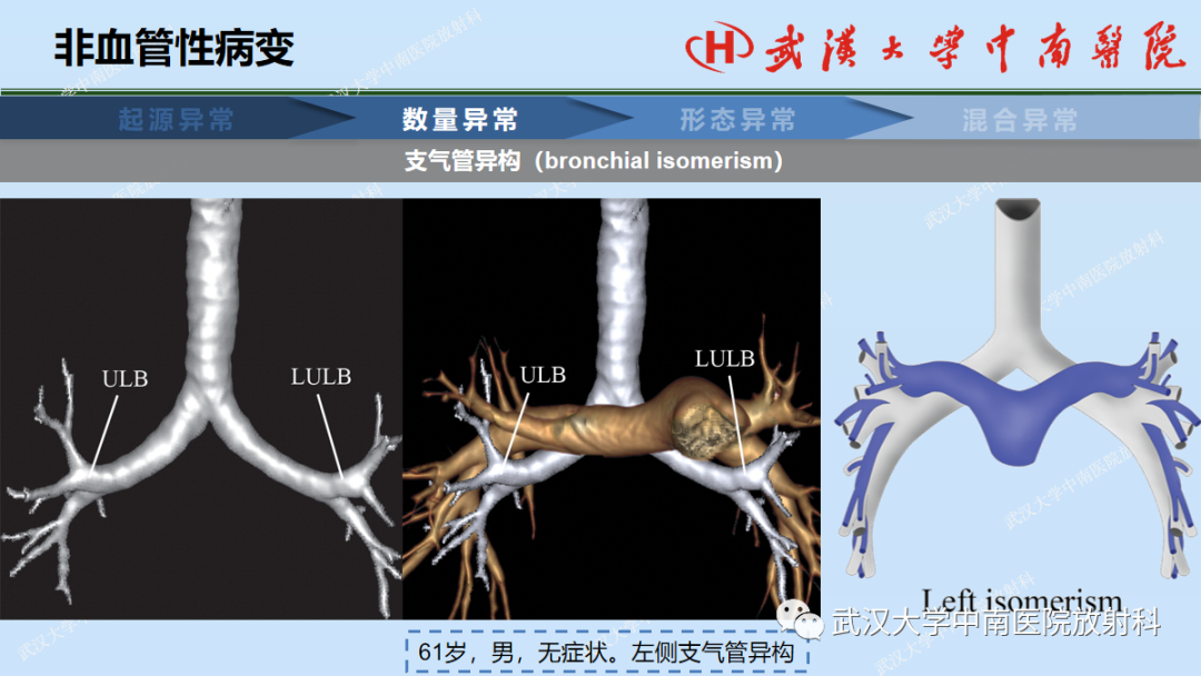 影像PPT - 【PPT】先天性气道异常-21