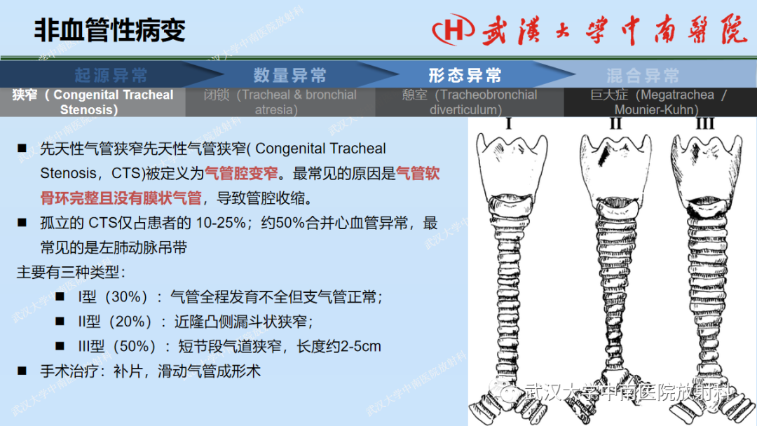 影像PPT - 【PPT】先天性气道异常-22