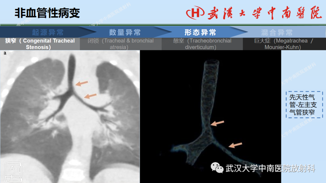 影像PPT - 【PPT】先天性气道异常-25