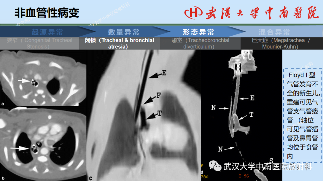 影像PPT - 【PPT】先天性气道异常-27