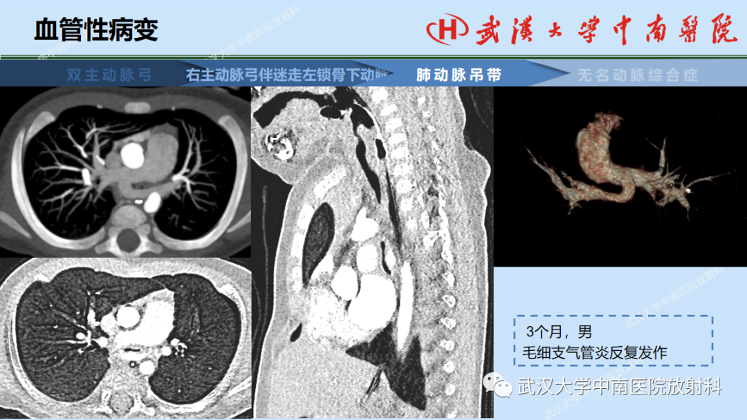 影像PPT - 【PPT】先天性气道异常-45