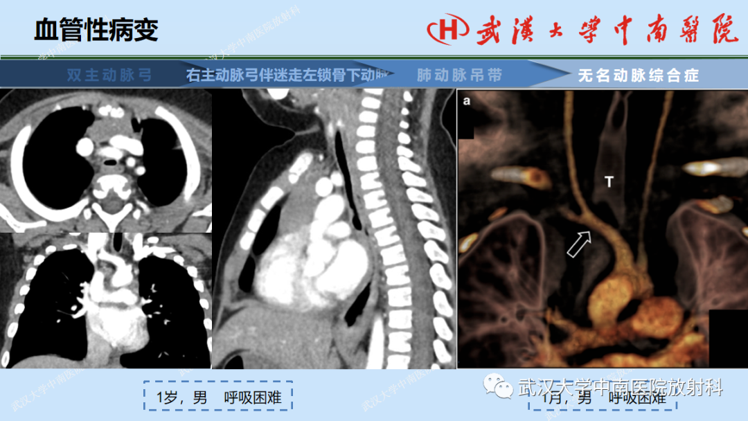 影像PPT - 【PPT】先天性气道异常-47