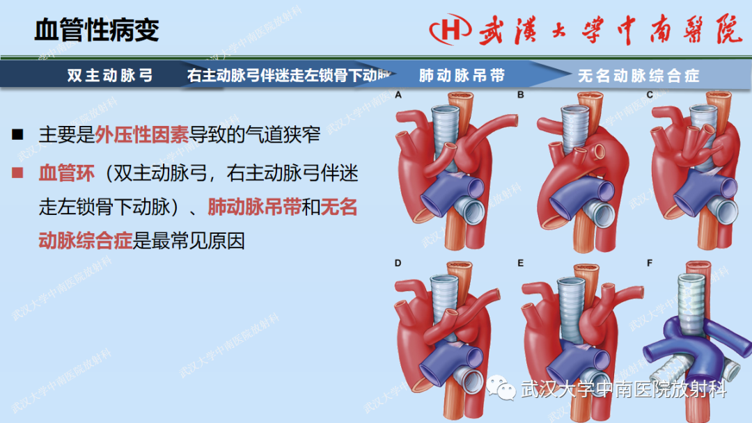 影像PPT - 【PPT】先天性气道异常-38