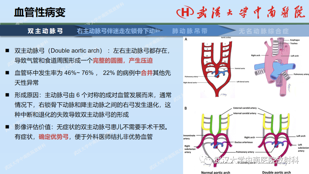 影像PPT - 【PPT】先天性气道异常-40