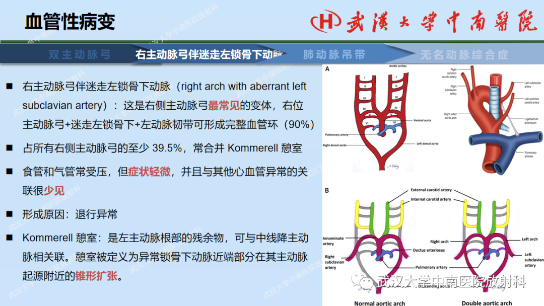 影像PPT - 【PPT】先天性气道异常-42