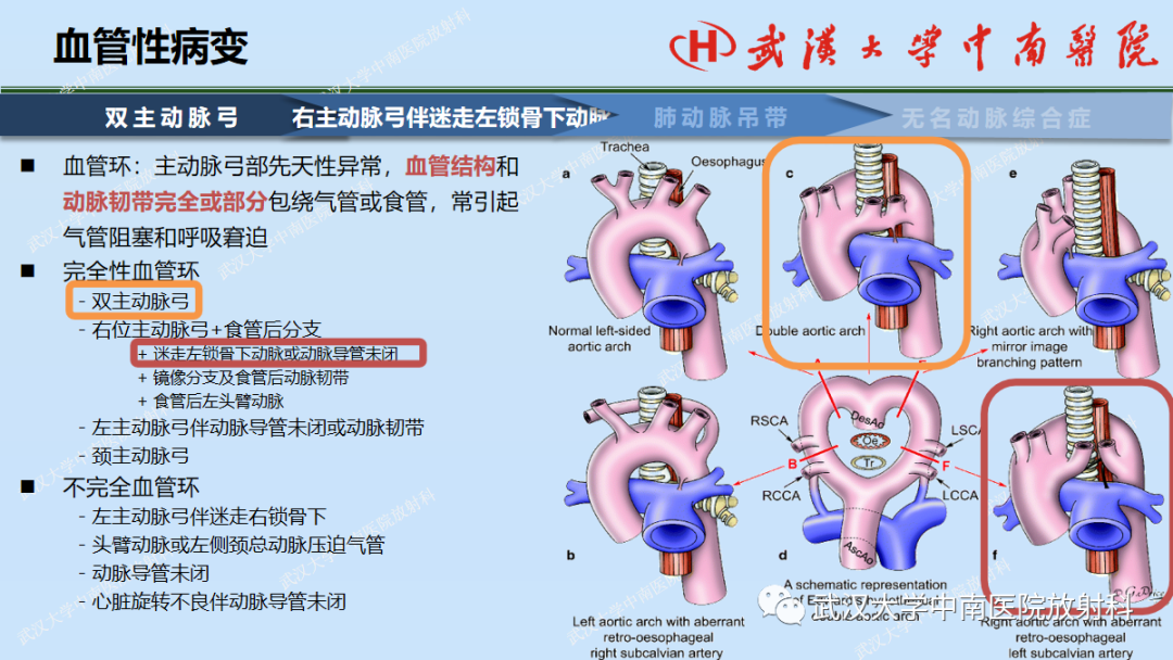 影像PPT - 【PPT】先天性气道异常-39