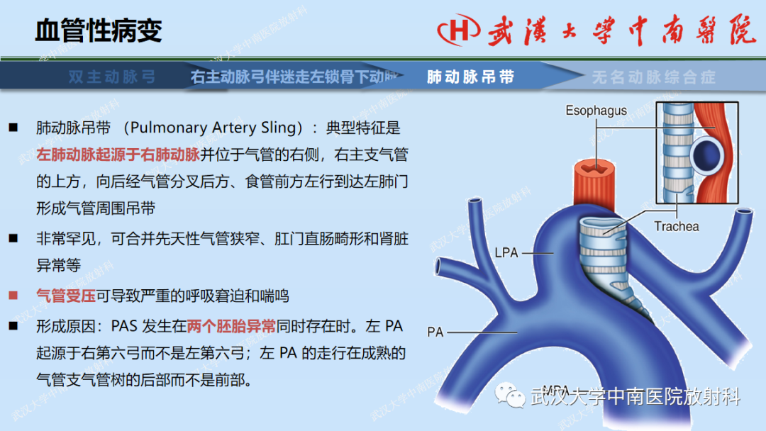 影像PPT - 【PPT】先天性气道异常-44