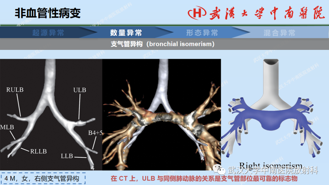 影像PPT - 【PPT】先天性气道异常-20
