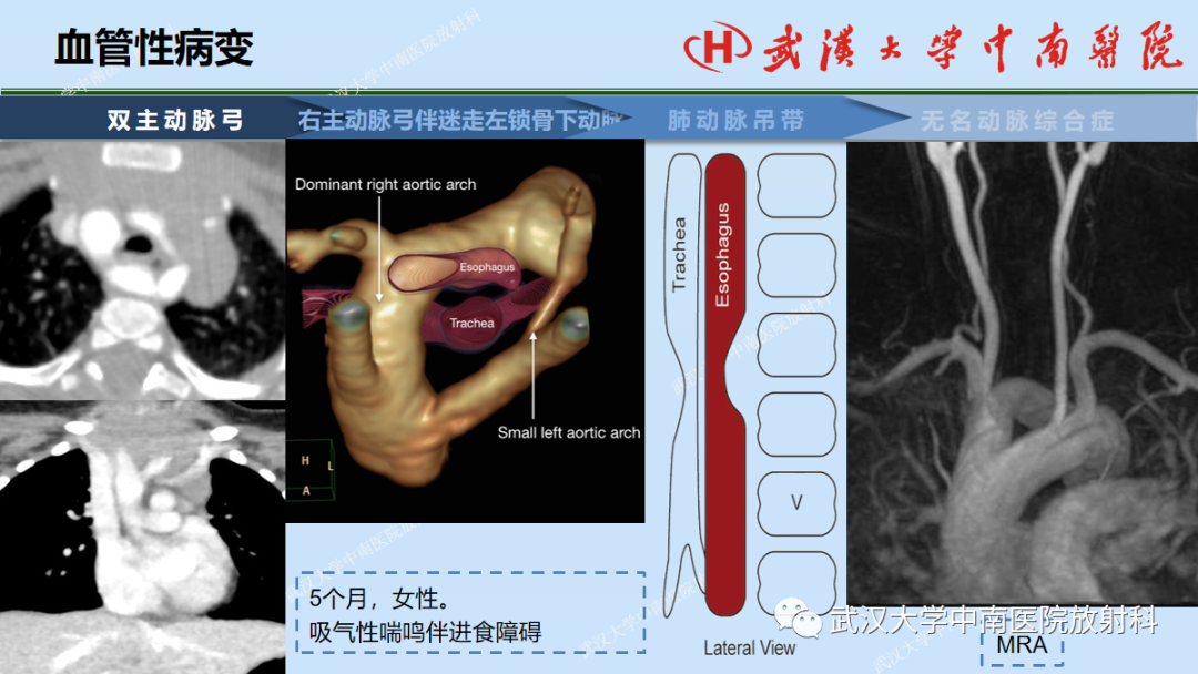 影像PPT - 【PPT】先天性气道异常-41
