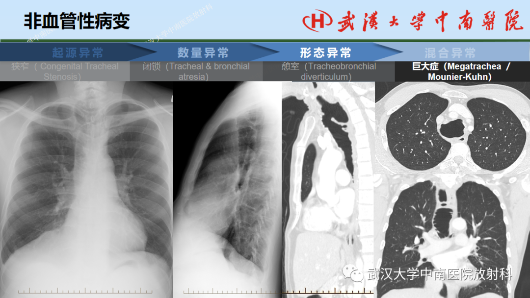 影像PPT - 【PPT】先天性气道异常-35