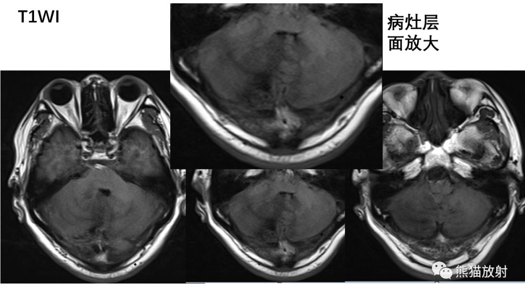 影像PPT - 【病例】后颅窝血管母细胞瘤2例MR-3