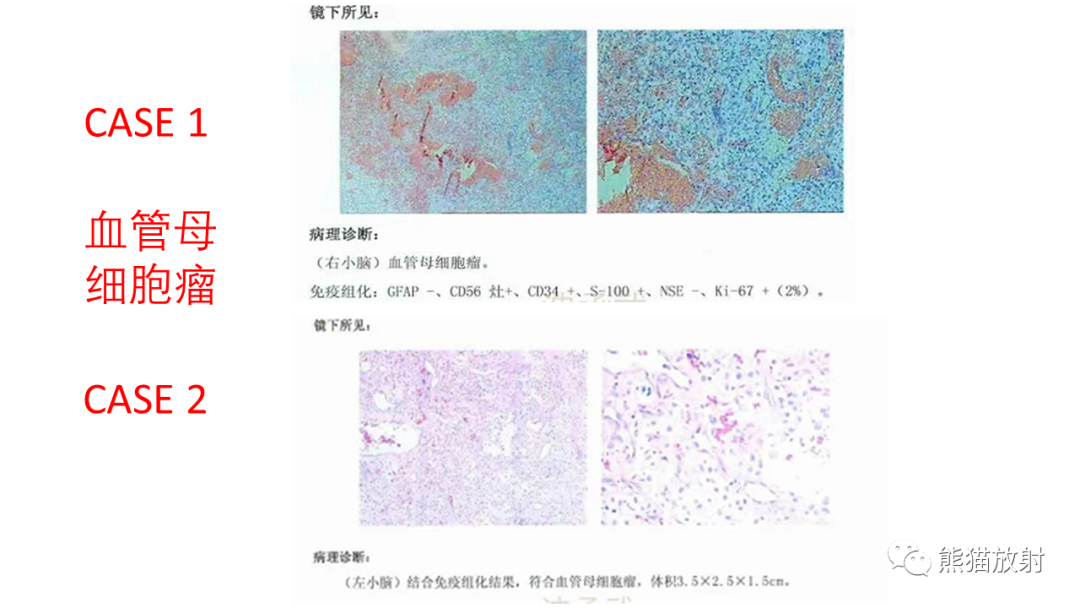 影像PPT - 【病例】后颅窝血管母细胞瘤2例MR-23