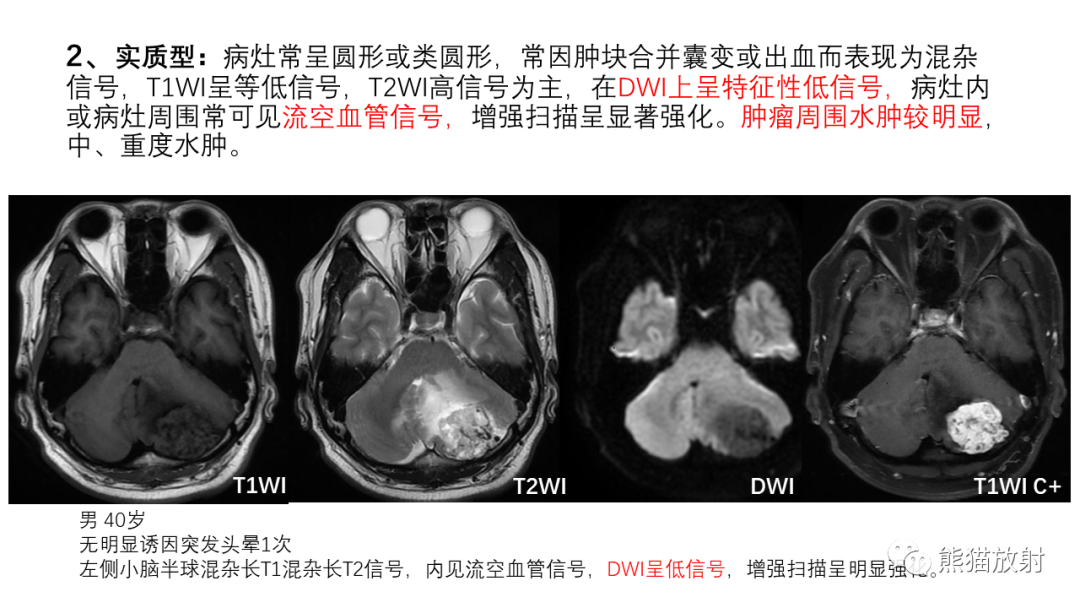影像PPT - 【病例】后颅窝血管母细胞瘤2例MR-27