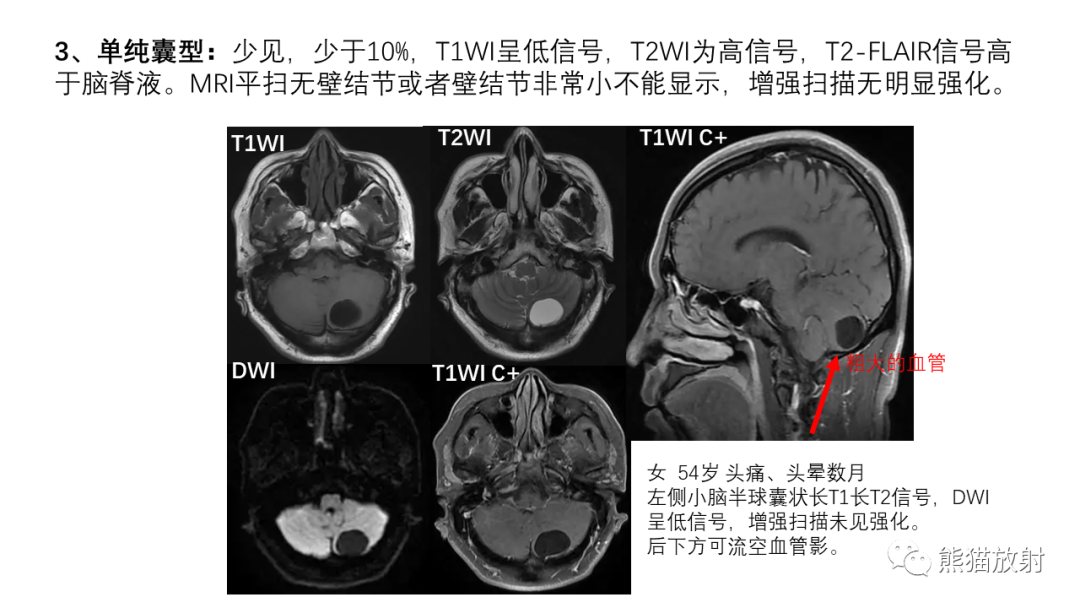 影像PPT - 【病例】后颅窝血管母细胞瘤2例MR-28
