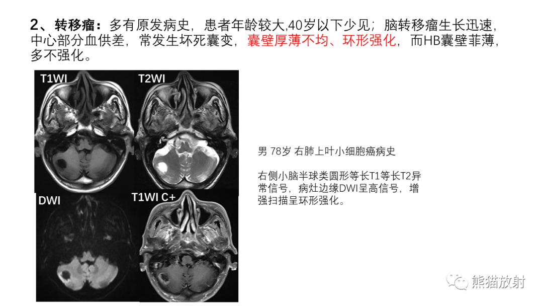 影像PPT - 【病例】后颅窝血管母细胞瘤2例MR-30