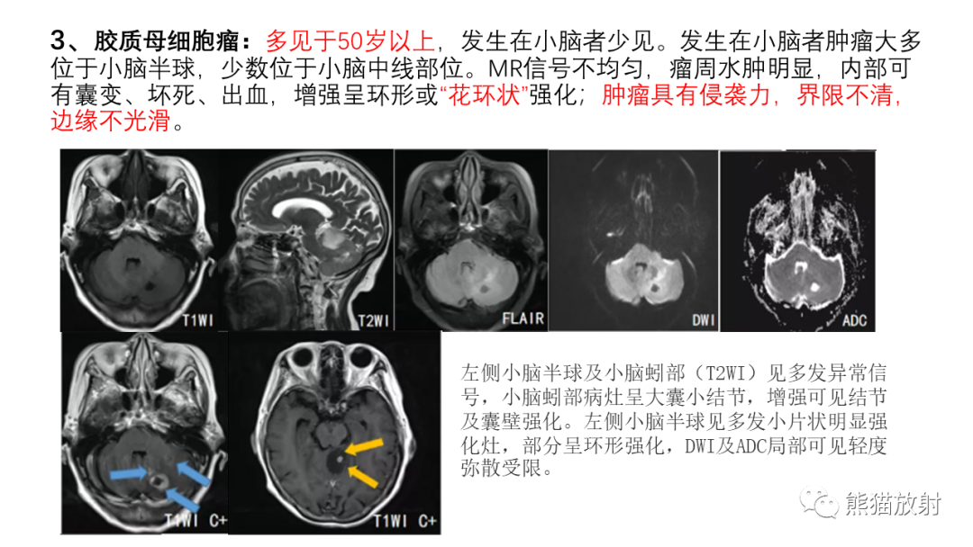 影像PPT - 【病例】后颅窝血管母细胞瘤2例MR-31