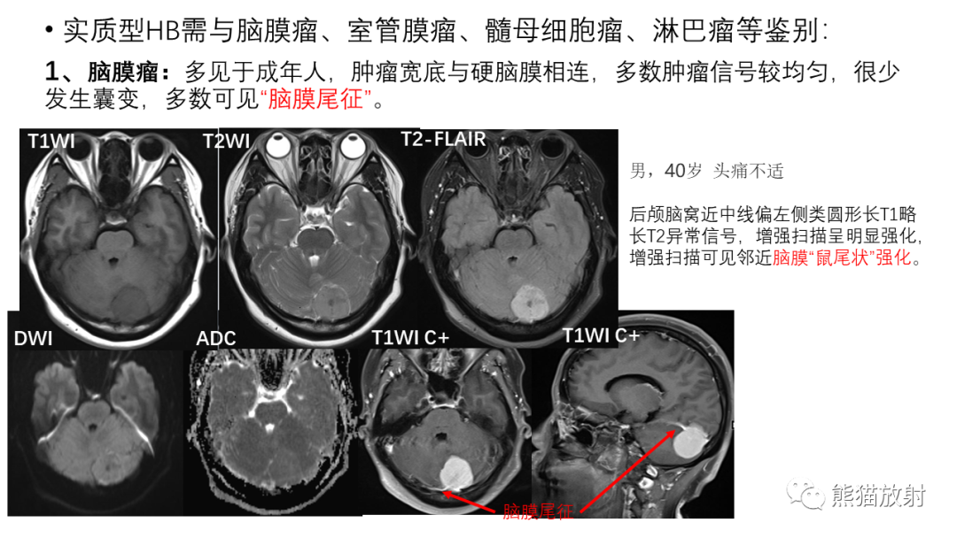 影像PPT - 【病例】后颅窝血管母细胞瘤2例MR-32