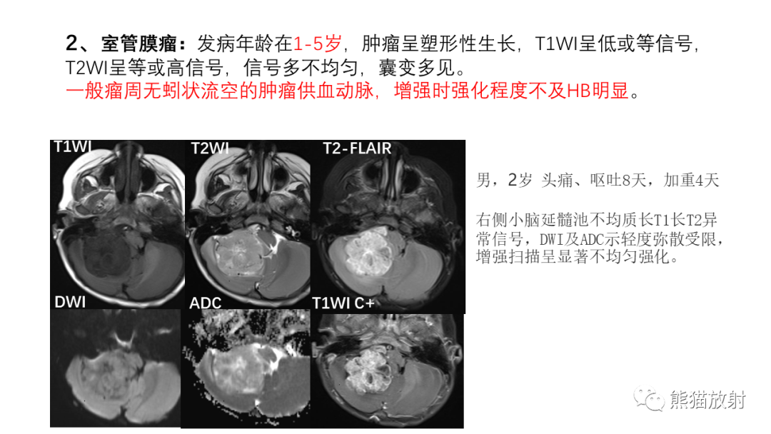 影像PPT - 【病例】后颅窝血管母细胞瘤2例MR-33