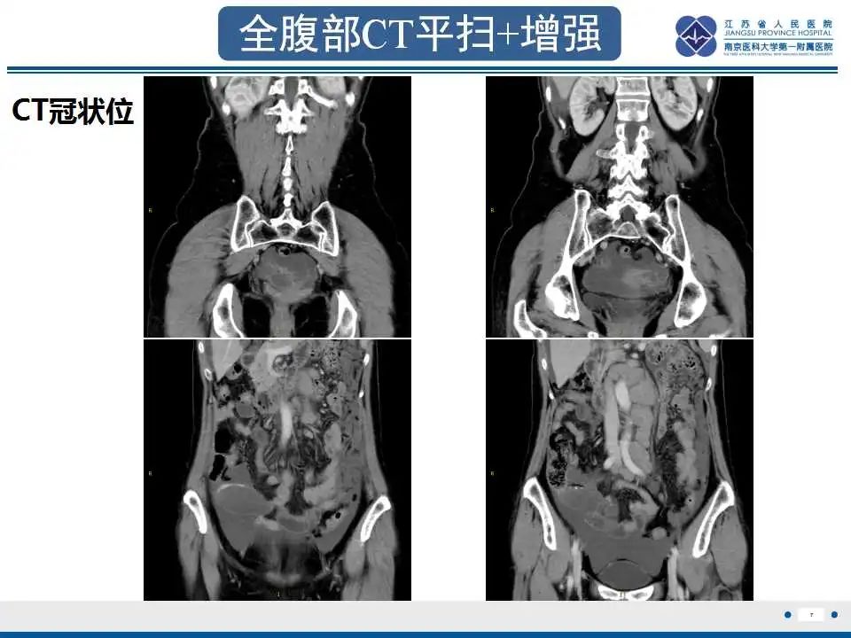影像PPT - 【PPT】阑尾黏液性肿瘤-8