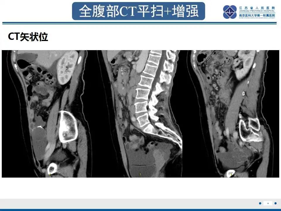 影像PPT - 【PPT】阑尾黏液性肿瘤-9