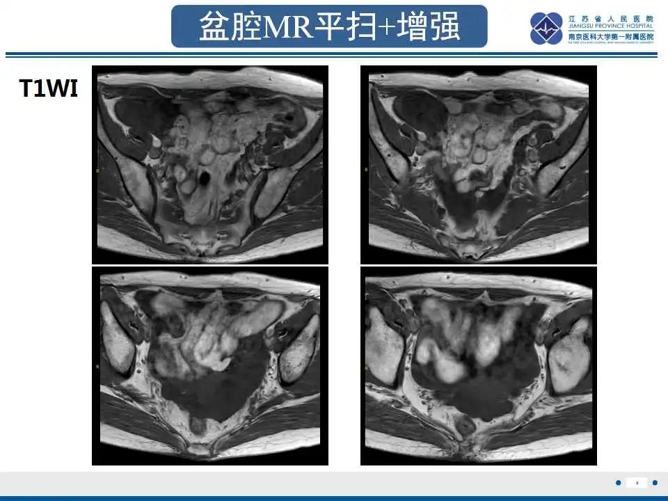 影像PPT - 【PPT】阑尾黏液性肿瘤-10