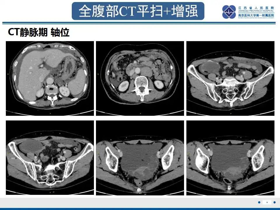 影像PPT - 【PPT】阑尾黏液性肿瘤-7
