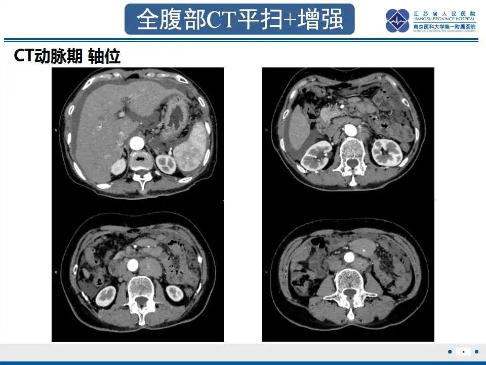 影像PPT - 【PPT】阑尾黏液性肿瘤-6
