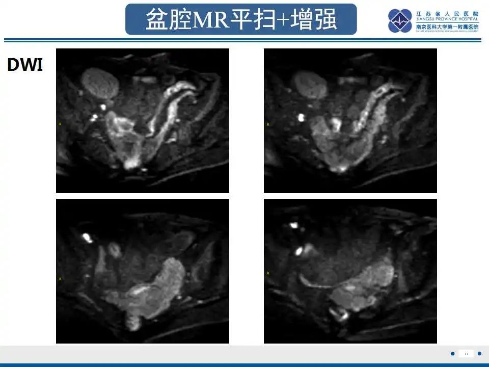 影像PPT - 【PPT】阑尾黏液性肿瘤-12