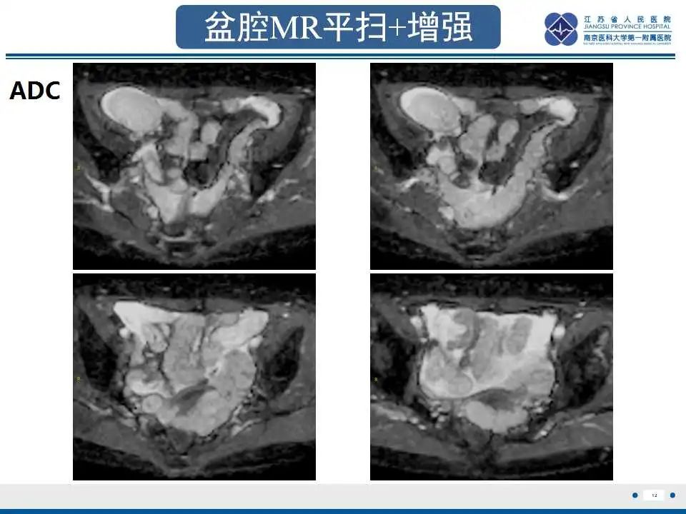 影像PPT - 【PPT】阑尾黏液性肿瘤-13