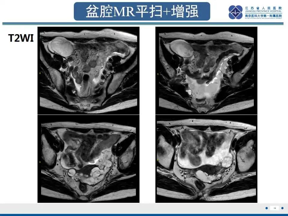 影像PPT - 【PPT】阑尾黏液性肿瘤-11
