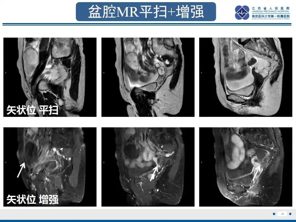 影像PPT - 【PPT】阑尾黏液性肿瘤-16