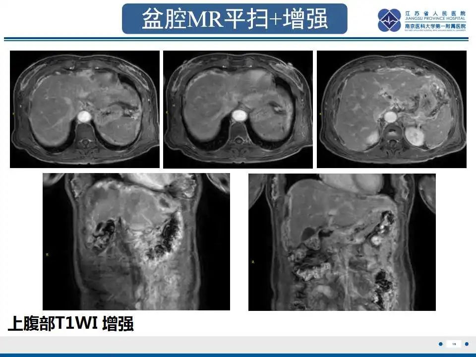 影像PPT - 【PPT】阑尾黏液性肿瘤-17
