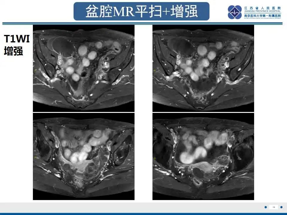 影像PPT - 【PPT】阑尾黏液性肿瘤-14