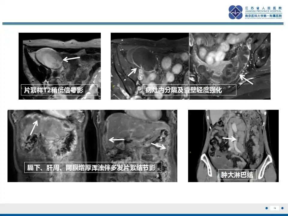 影像PPT - 【PPT】阑尾黏液性肿瘤-20