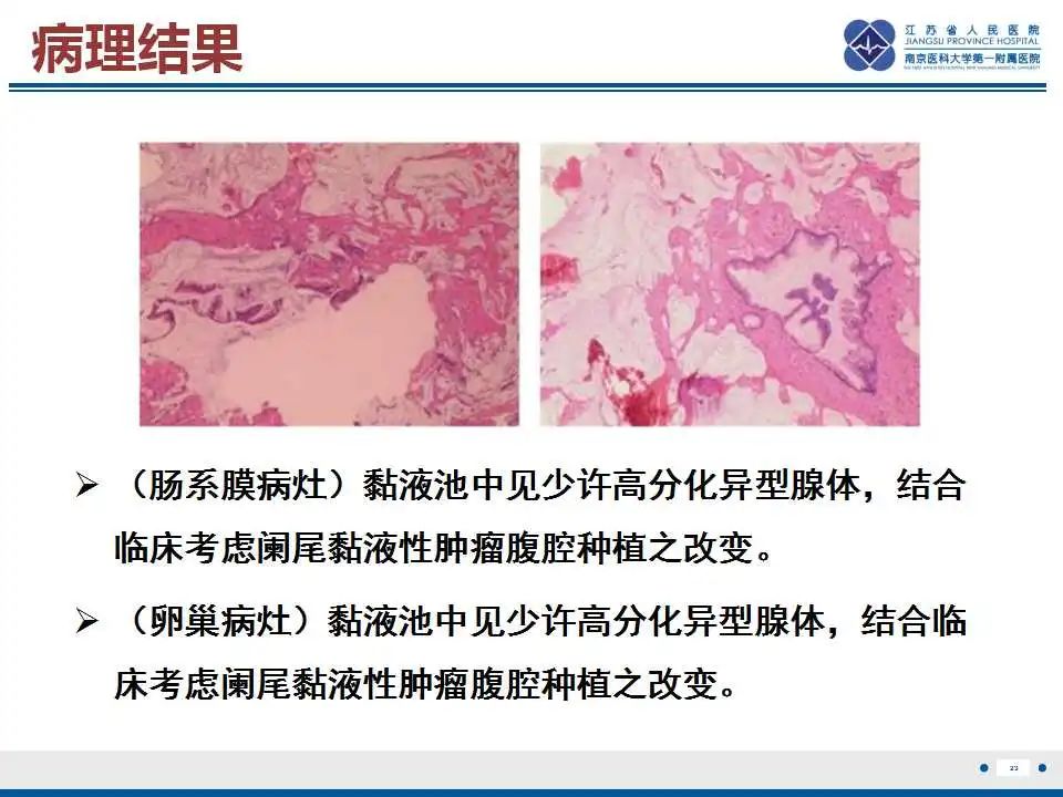 影像PPT - 【PPT】阑尾黏液性肿瘤-24