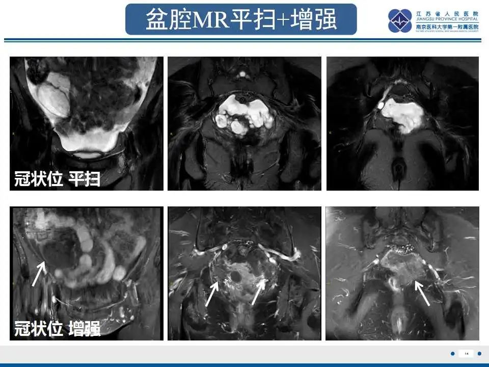 影像PPT - 【PPT】阑尾黏液性肿瘤-15
