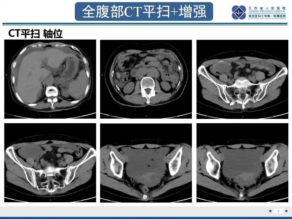 影像PPT - 【PPT】阑尾黏液性肿瘤-5